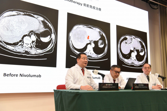 Following the significant effects of the ‘dual immunotherapy’, the new combination treatment has been approved from the FDA, EMA and NMPA for previously untreated advanced HCC patients. The research team includes (from left) Professor Cheung Tan-to, Dr Thomas Yau Chung-cheung and Dr Ronald Leung Ching-yu.
 